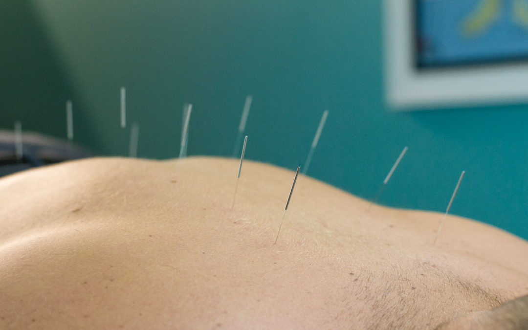 Dry Needling and Acupuncture: What’s the difference?