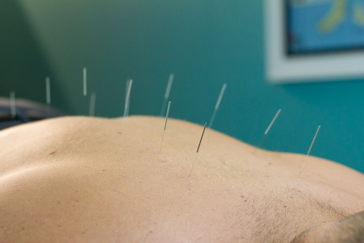 Dry Needling and Acupuncture: What’s the difference?